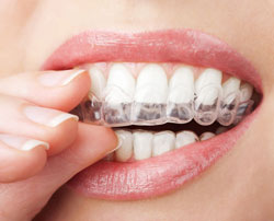 Invisalign | Dentist In Monroe, MI | Jeanette C. Murphy DDS, PLC